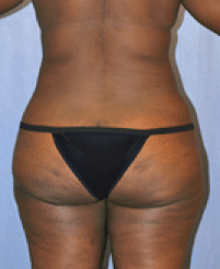 After Image: Tummy Tuck - back