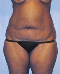 Before Image: Tummy Tuck - front