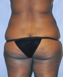 Before Image: Tummy Tuck - back