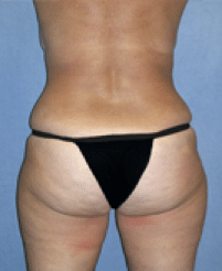 After Image: Tummy Tuck - back