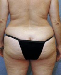 Before Image: Tummy Tuck - back