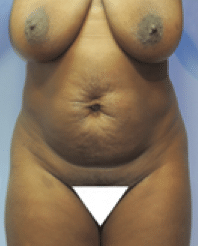 Before Image: Tummy Tuck - front