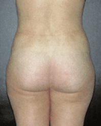 After Image: Tummy Tuck - back