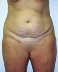 Before Image: Tummy Tuck - front
