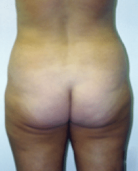 Before Image: Tummy Tuck - back