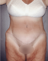 After Image: Tummy Tuck - front