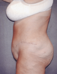 After Image: Tummy Tuck - left-side