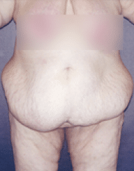 Before Image: Tummy Tuck - front