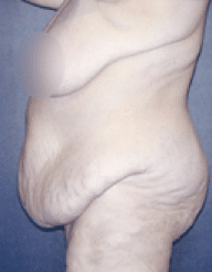 Before Image: Tummy Tuck - left-side