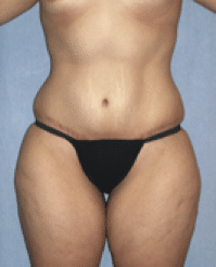 After Image: Tummy Tuck - front