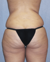 After Image: Tummy Tuck - back