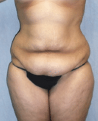 Before Image: Tummy Tuck - front