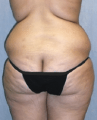 Before Image: Tummy Tuck - back