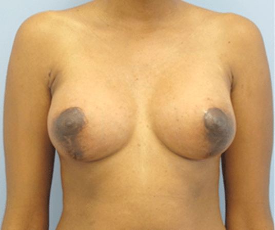 After Image: Tubular Breast Syndrome - front