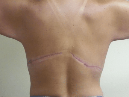 After Image: Upper Body Back Lift - back