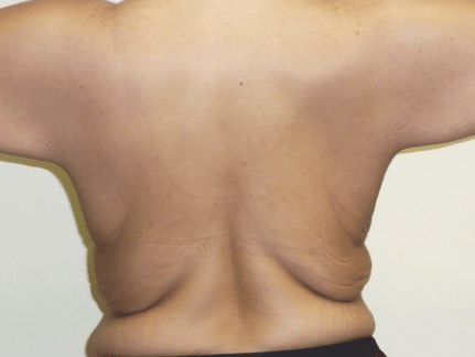 Before Image: Upper Body Back Lift - back