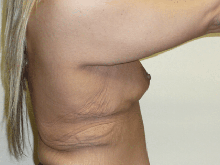 Before Image: Upper Body Back Lift - right-side