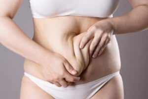 Woman with excess abdominal skin after weight loss, needling body contouring